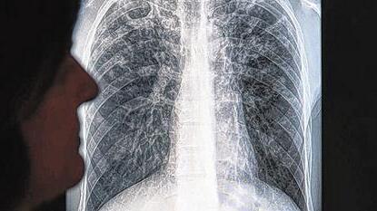 Von Tuberkulose befallene Lunge