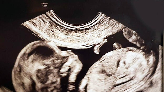 Ultraschallbild eines Babys in der 9. bis 12. Schwangerschaftswoche